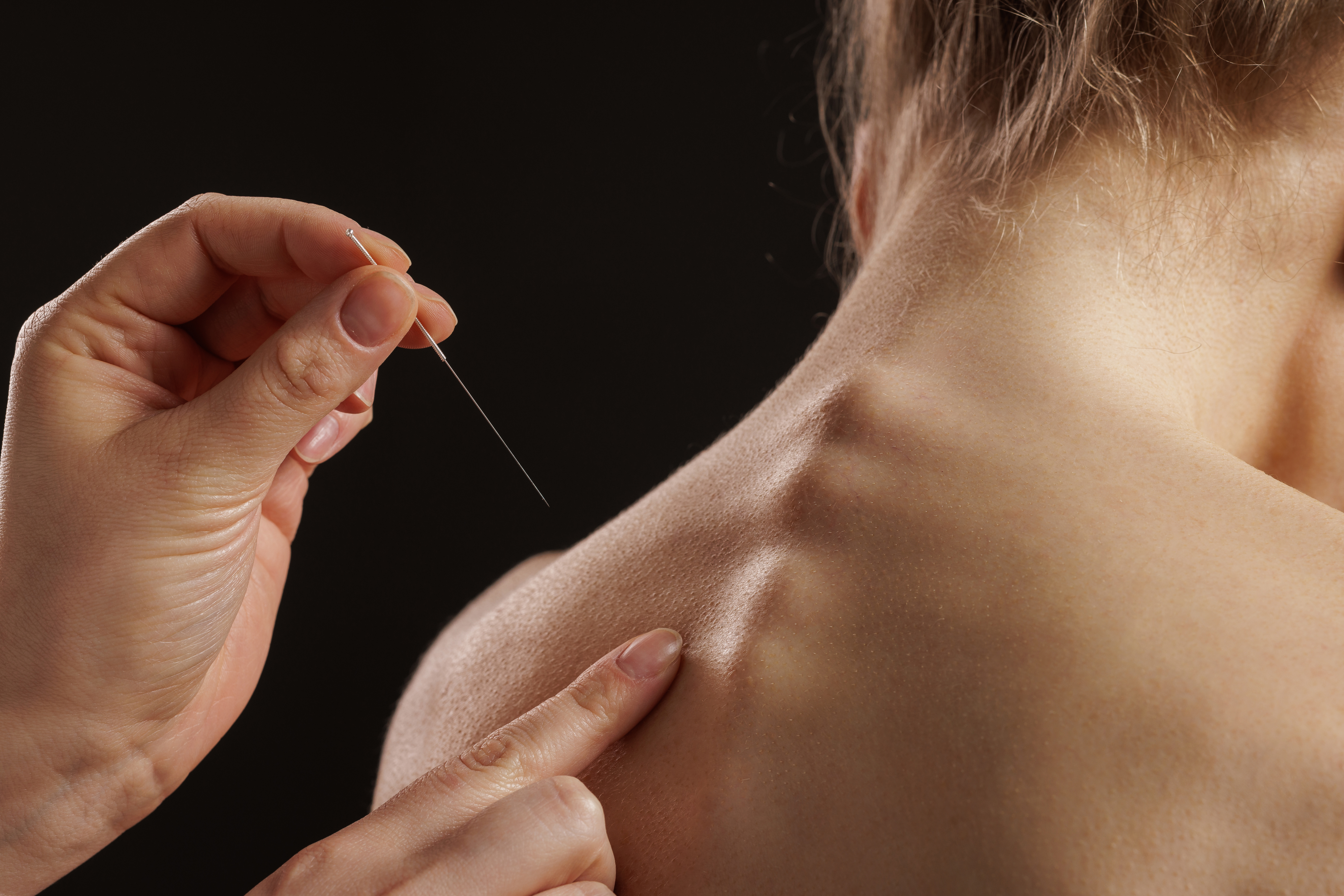 Close up of dry needling technique on neck for pain relief muscle therapy and rehabilitation in physical therapy