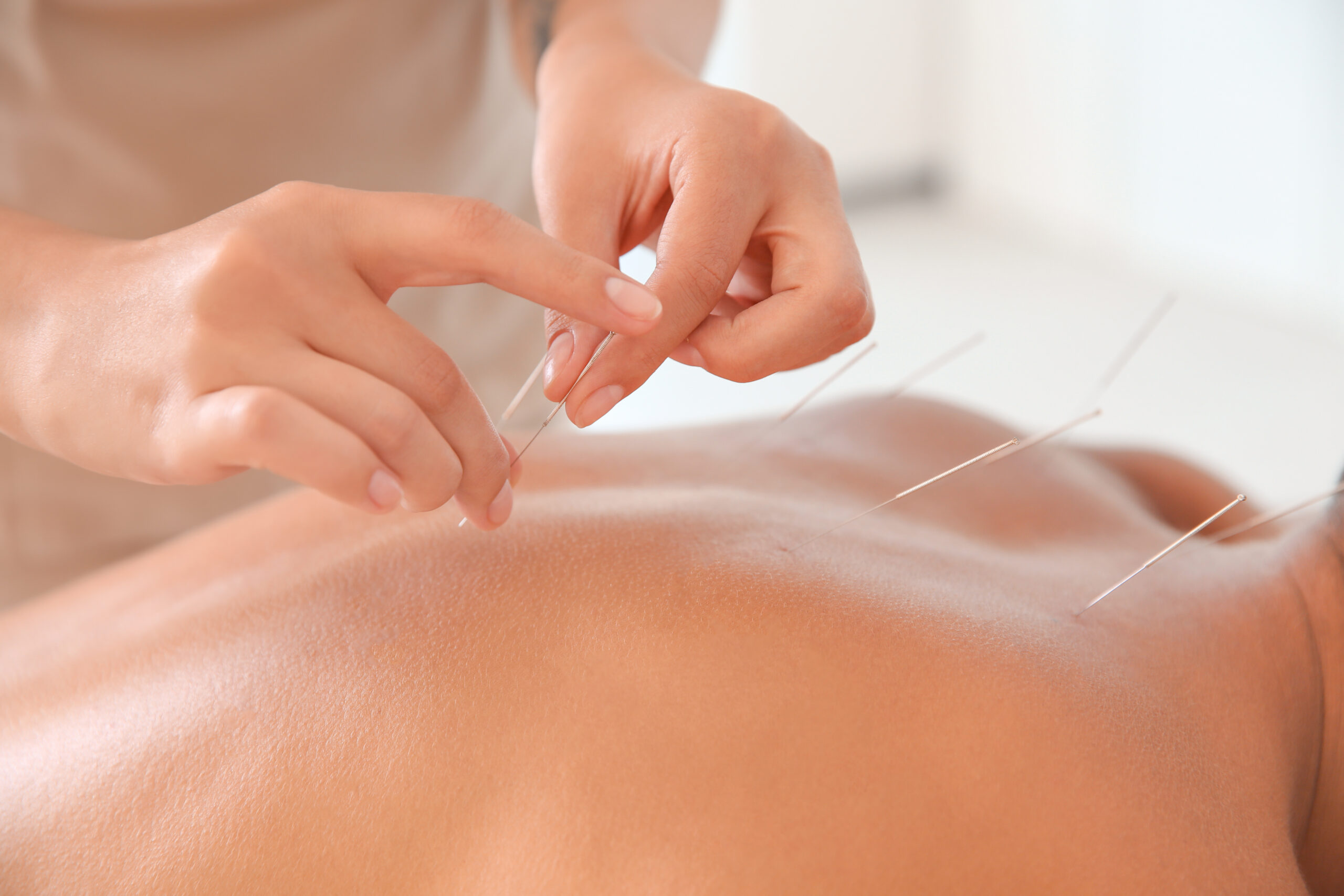 Young man undergoing acupuncture treatment in salon, closeup.