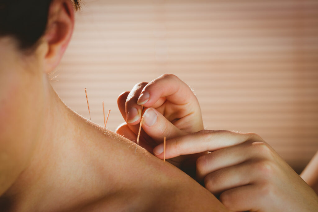 Young woman getting acupuncture treatment in therapy room.