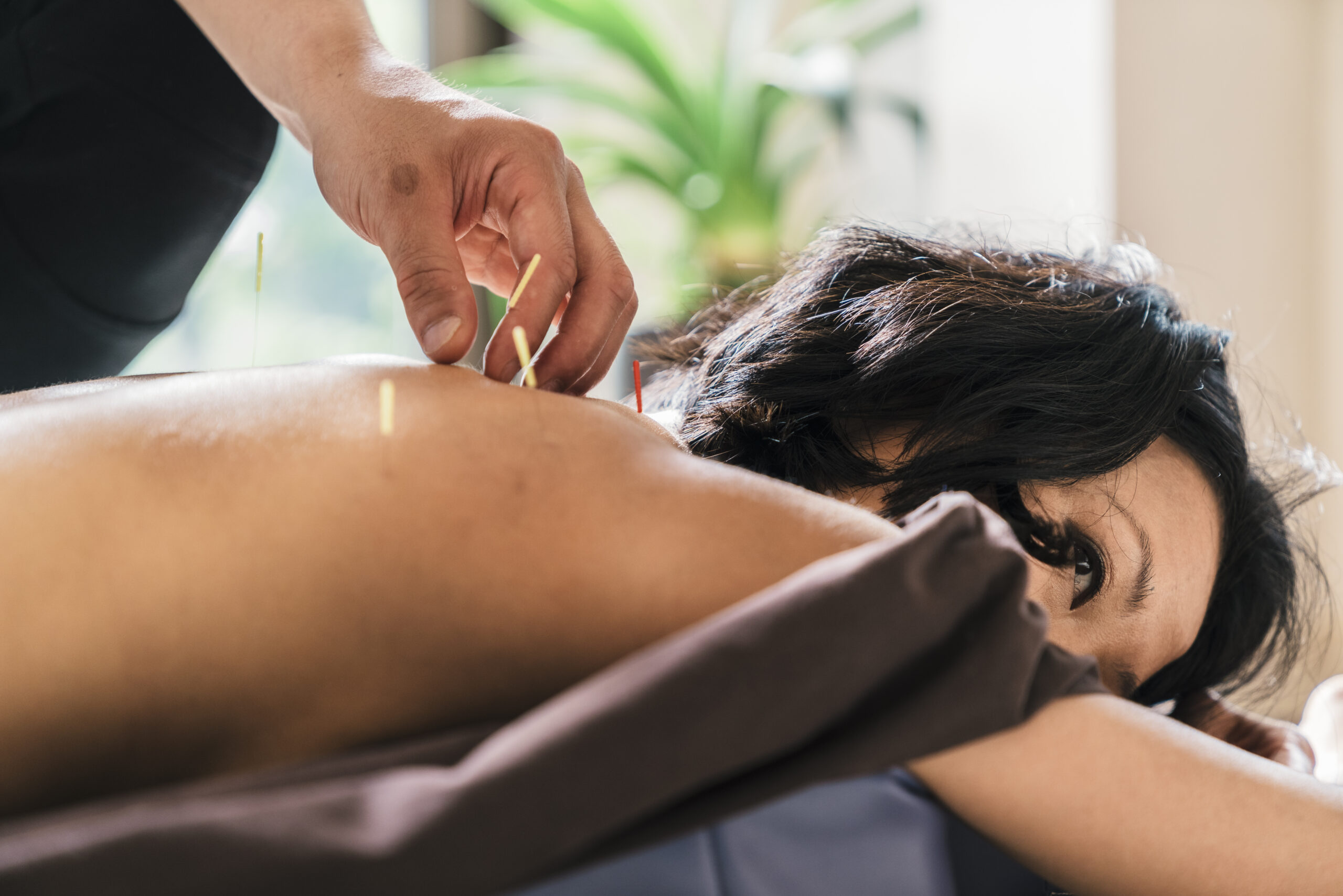 Therapist Giving acupuncture Treatment To Young Asian Woman.